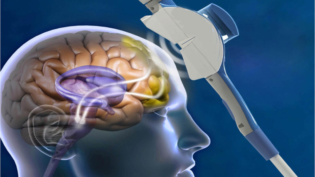 TMS device on brain